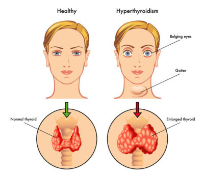 How’s Your Thyroid? | Dr. Chris Barker